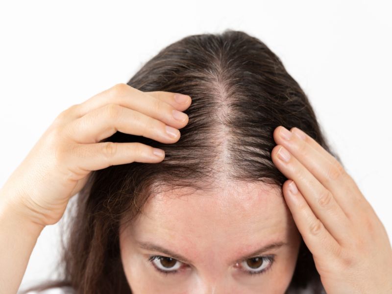 A woman having a thinning hair